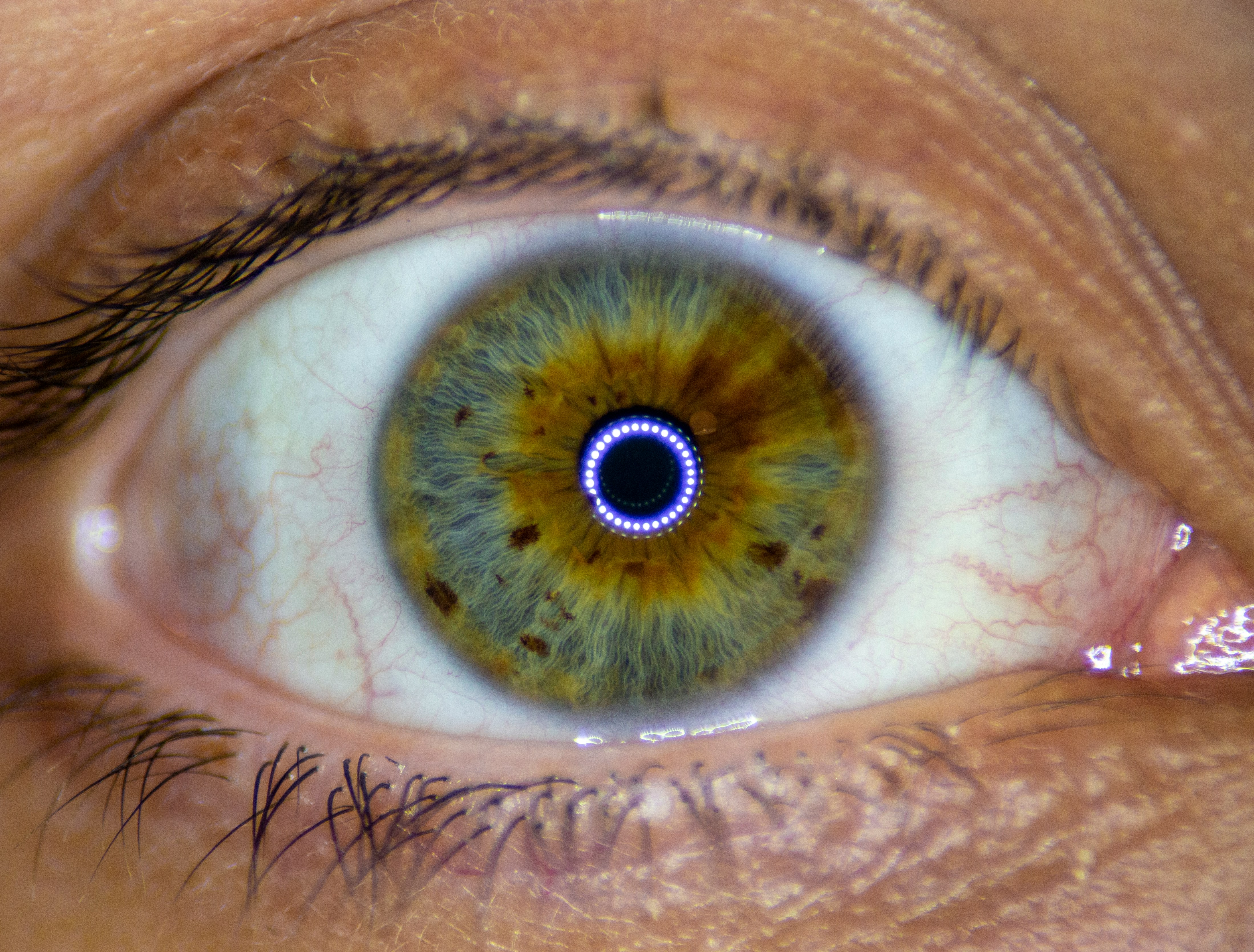 LASIK eye surgery abroad insurance for US patients